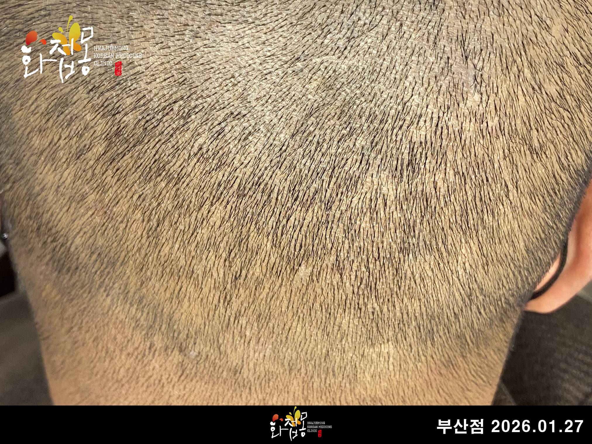 전후사진