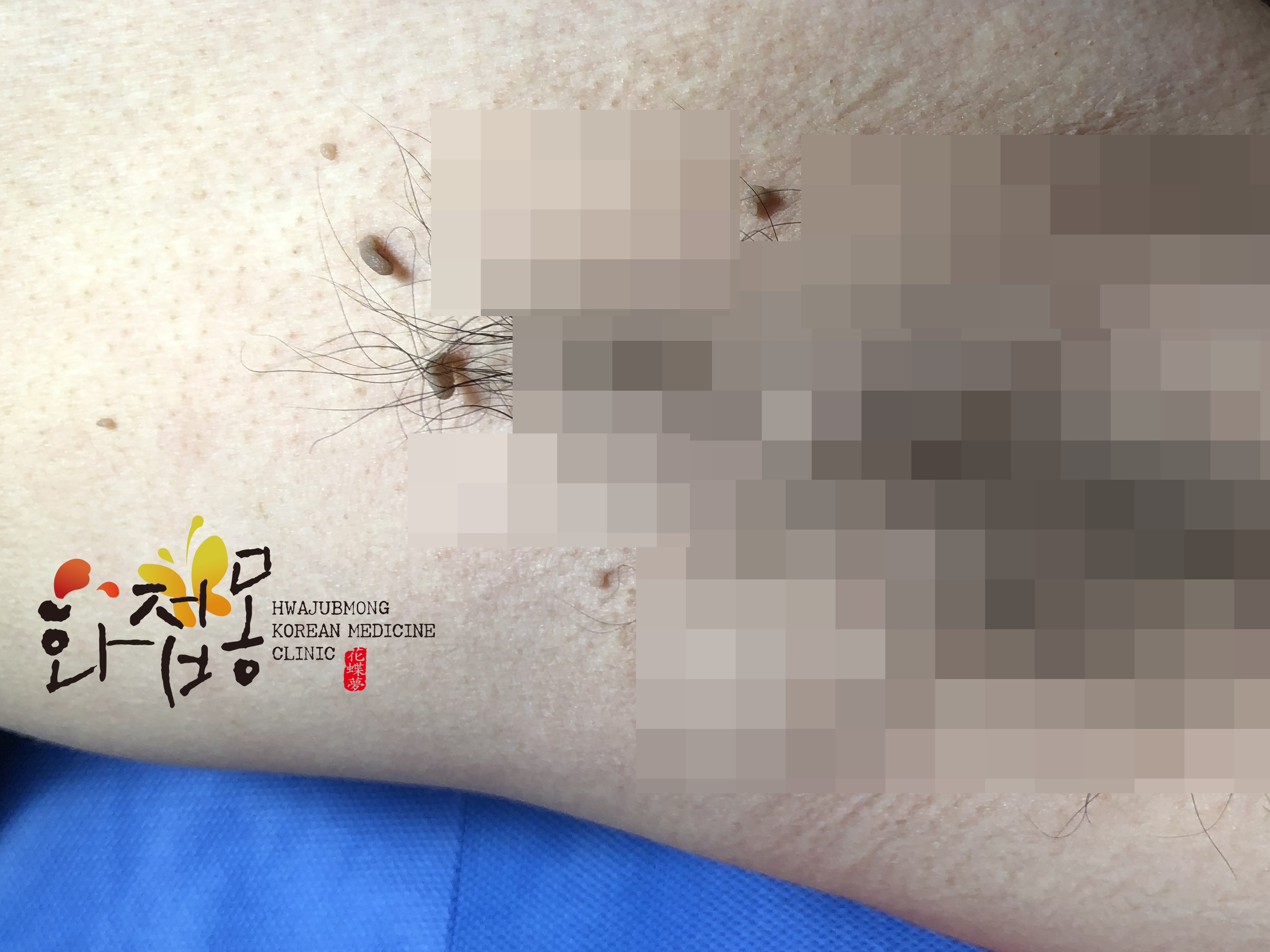 전후사진