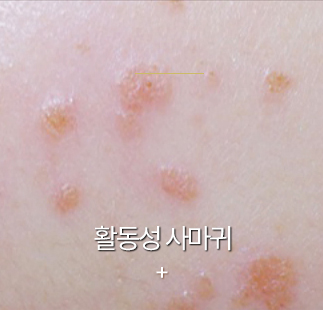 편평사마귀