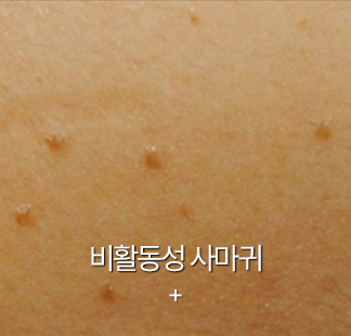 편평사마귀
