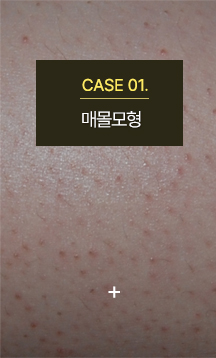 모공각화증
