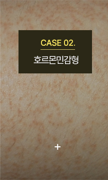 모공각화증