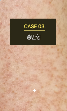 모공각화증