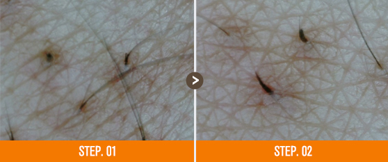 모공각화증